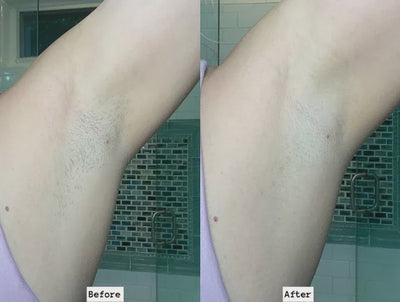 Luness RadiancePro™ Hair Removal System