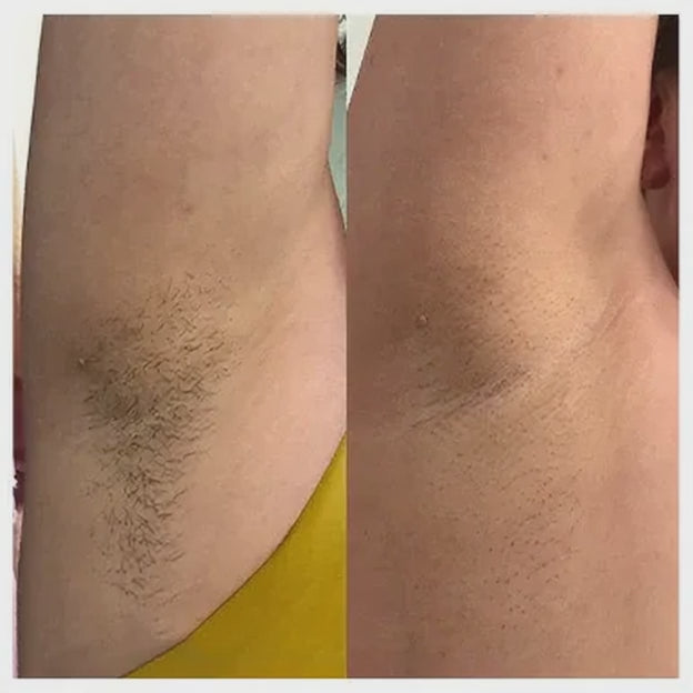 Luness RadiancePro™ Hair Removal System