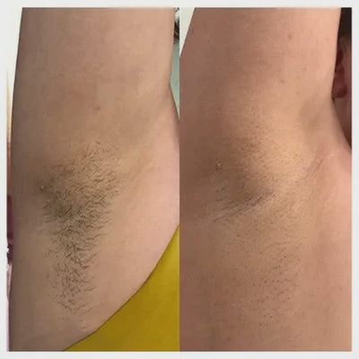 Luness RadiancePro™ Hair Removal System
