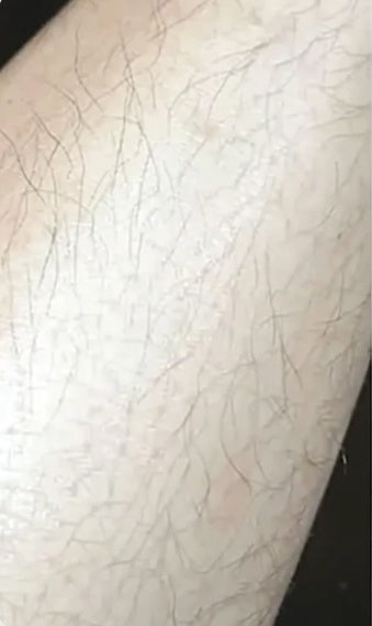 Underarm at week 0